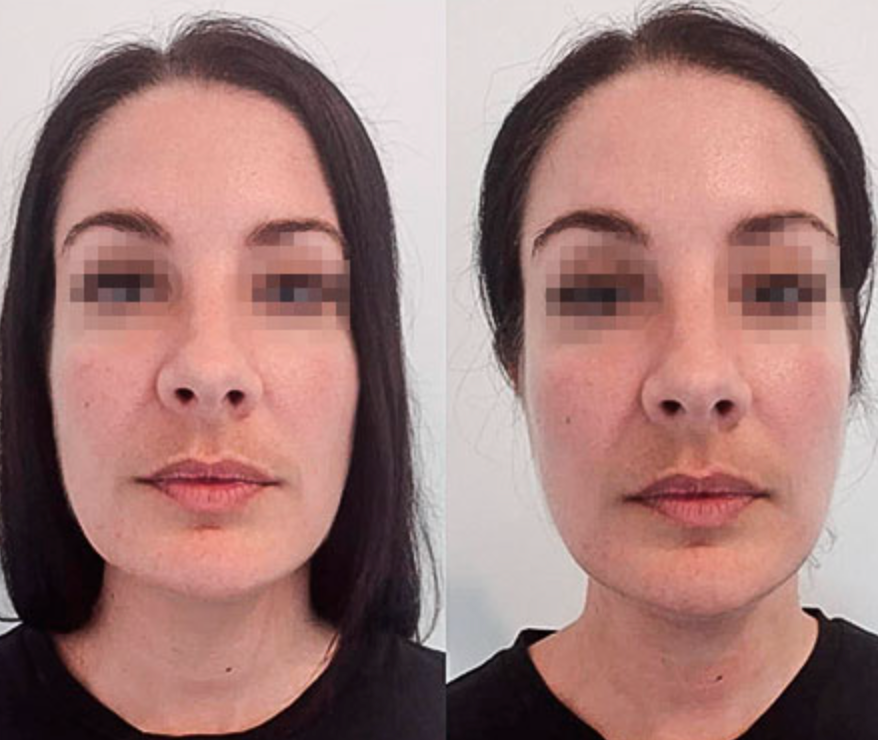 Liquid Lymphatic Drainage – Slimmer Face, Lighter Legs, Flatter Belly