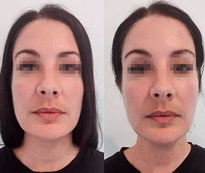 Liquid Lymphatic Drainage – Slimmer Face, Lighter Legs, Flatter Belly